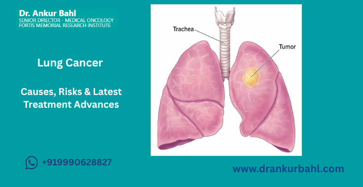 Lung Cancer – Causes, Risks & Latest Treatment Advances