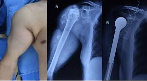 Bone Cancer Treatment in India