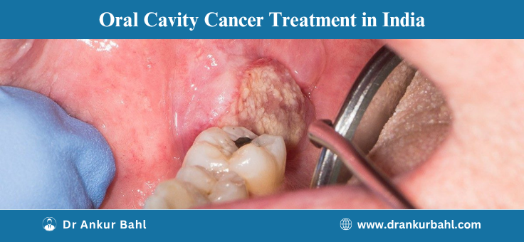 Oral Cancer Treatment Cost in India