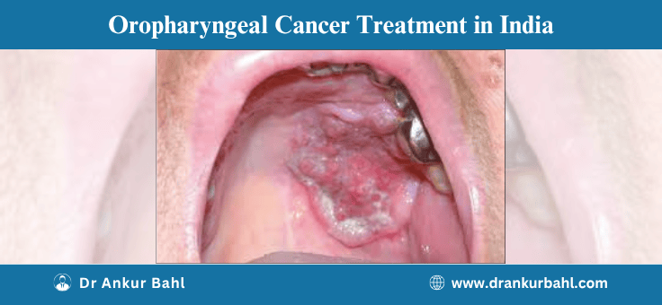 Oropharyngeal Cancer Treatment in India