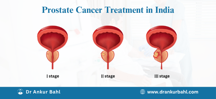 Prostate Cancer Treatment Cost in India