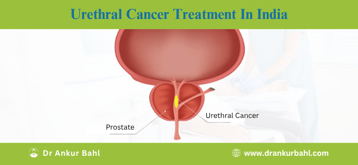 Urethral Cancer Treatment in India