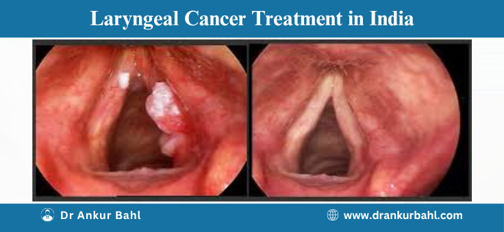 Laryngeal Cancer Treatment in India