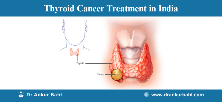 Thyroid Cancer Treatment in India