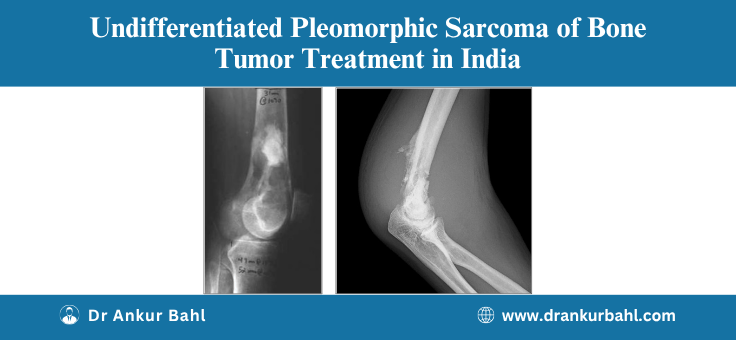 Undifferentiated Pleomorphic Sarcoma of Bone Treatment in India