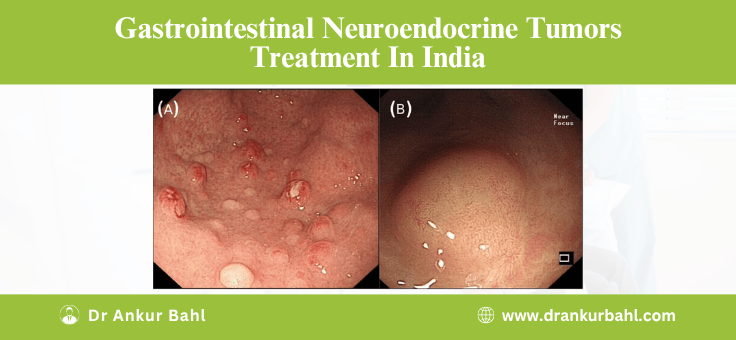 Gastrointestinal Neuroendocrine Tumors Treatment in India