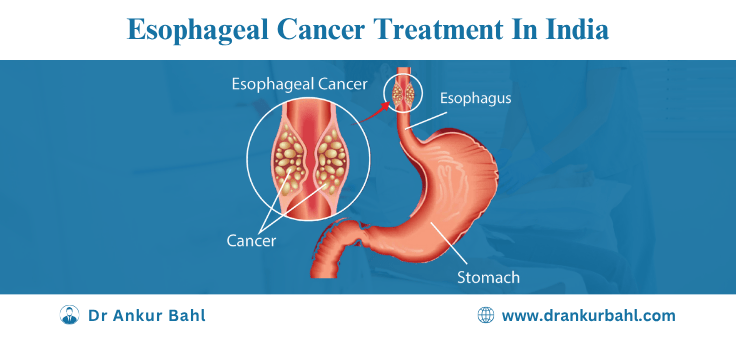 Esophageal Cancer Treatment in India