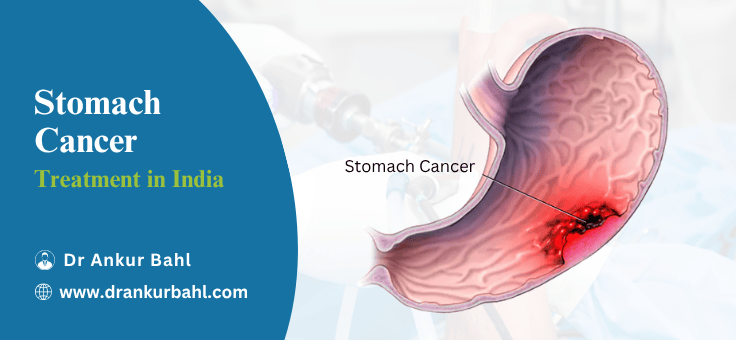 Stomach (Gastric) Cancer Treatment in India