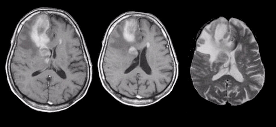 AIDS-Related Lymphoma (ARL) Treatment in India