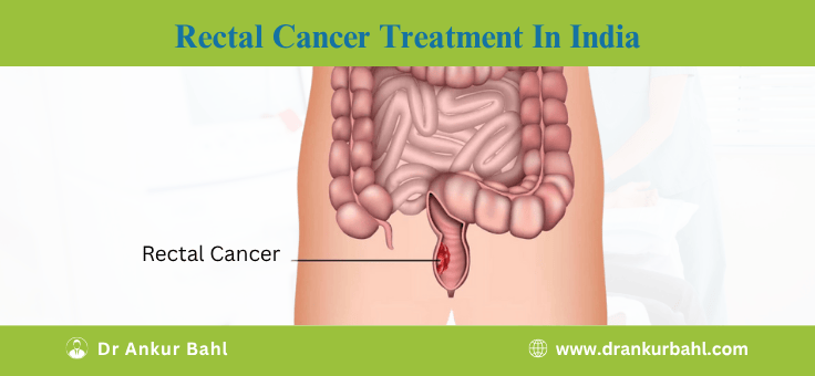 Rectal Cancer Treatment in India