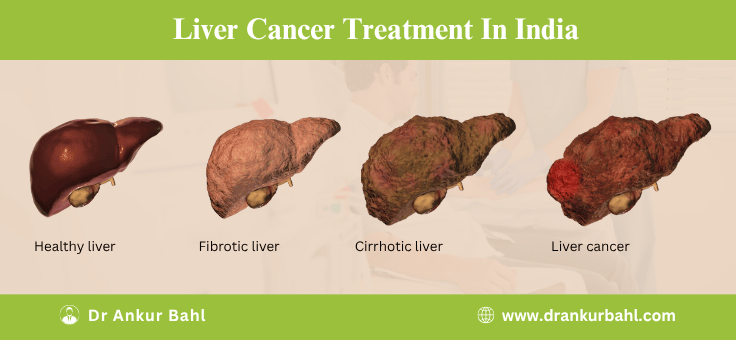 Liver Cancer Treatment Cost in India