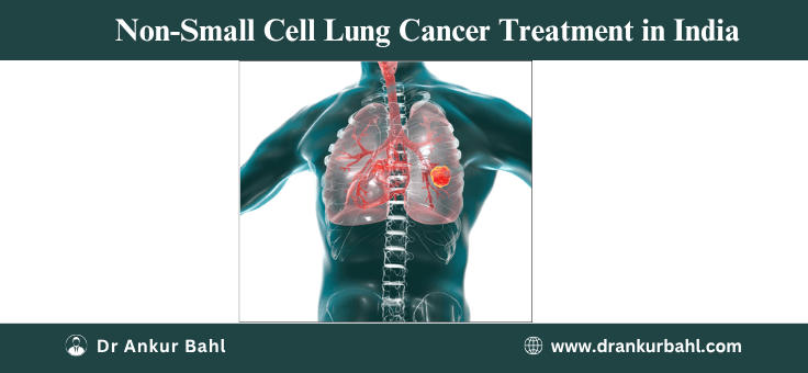 Non-Small Cell Lung Cancer Treatment in India