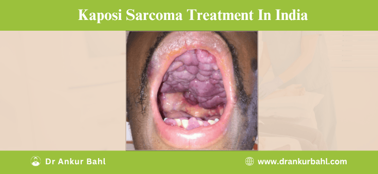 Kaposi Sarcoma Treatment in India