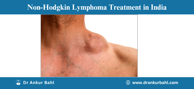 Non-Hodgkin Lymphoma Treatment in India