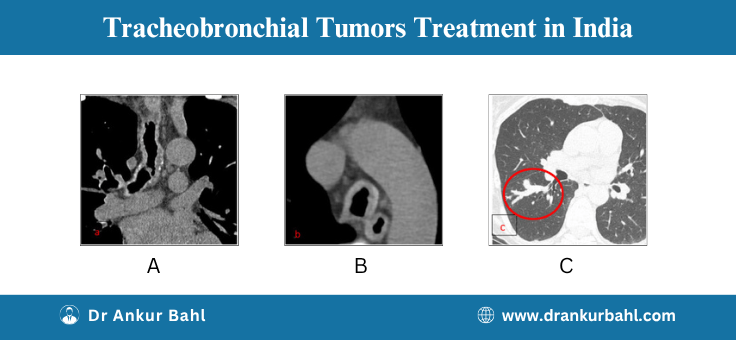 Tracheobronchial Tumors (Lung Cancer) Treatment in India