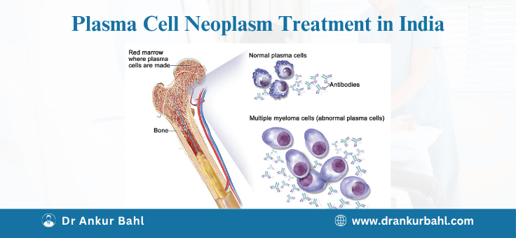 Multiple Myeloma (Plasma Cell Neoplasm) Treatment in India