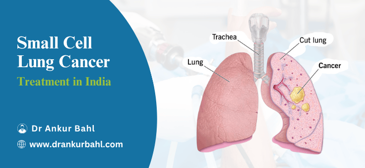 Small Cell Lung Cancer Treatment Cost in India