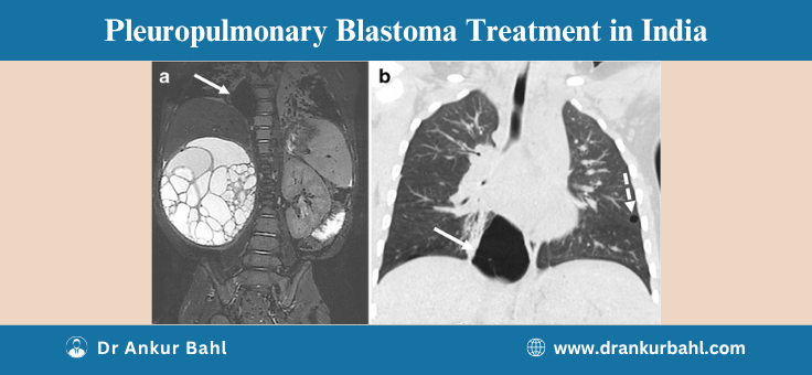 Pleuropulmonary Blastoma Treatment in India