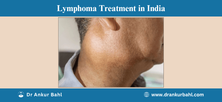 Lymphoma Treatment in India