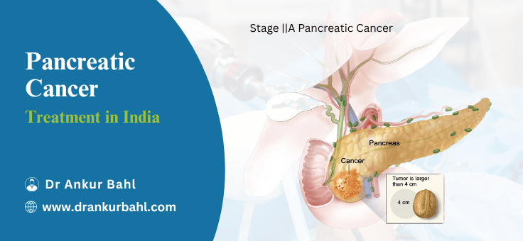 Pancreatic Cancer Treatment in India