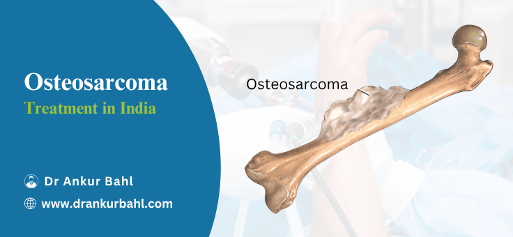 Osteosarcoma Treatment in India