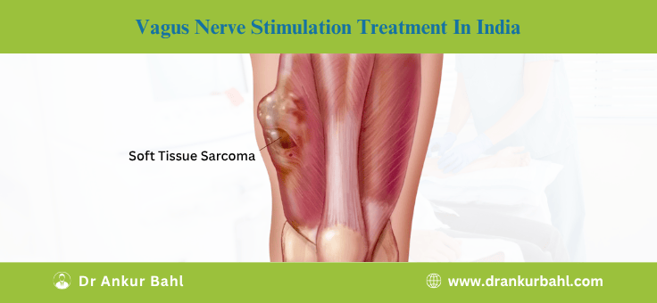 Sarcoma Treatment in India