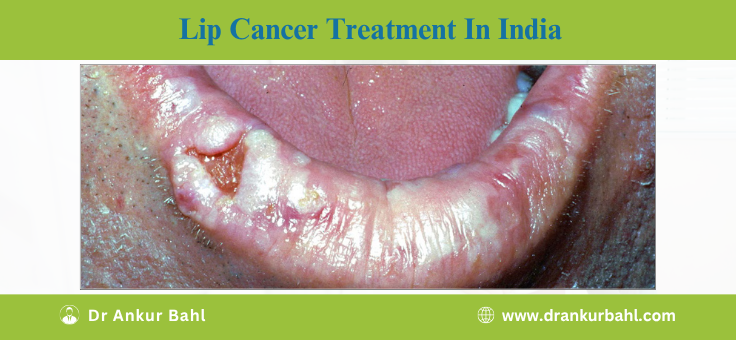 Lip Cancer Treatment in India
