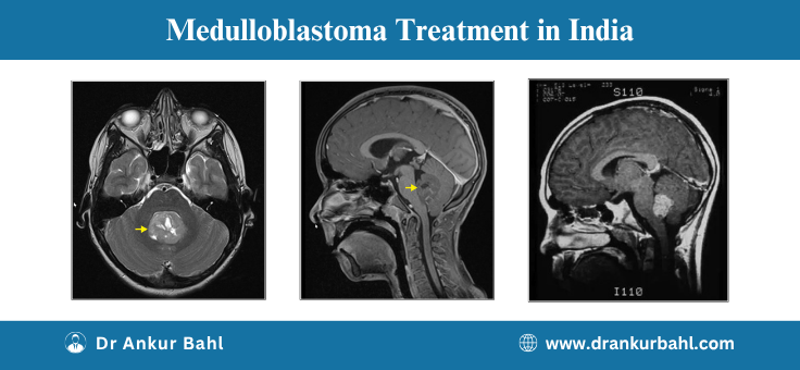 Medulloblastoma Treatment in India