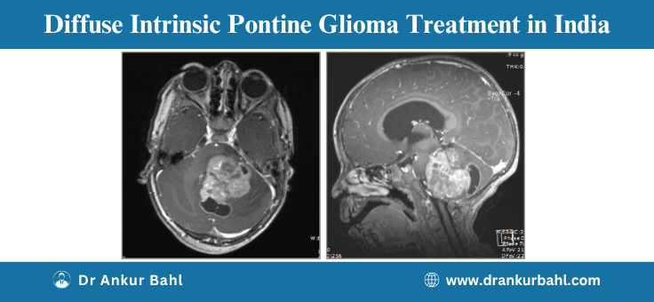 Diffuse Intrinsic Pontine Glioma (DIPG) Treatment in India