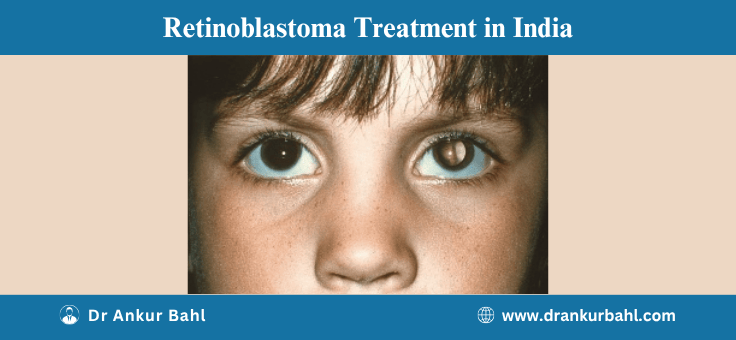 Retinoblastoma Treatment in India