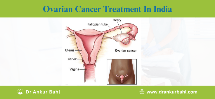 Ovarian Cancer Treatment in India