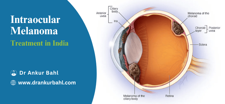 Intraocular Melanoma Treatment in India