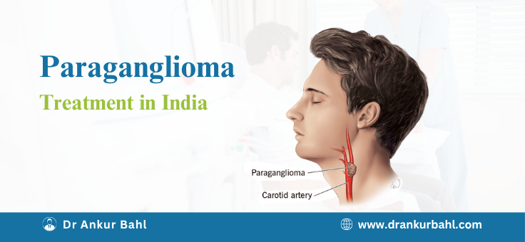 Paraganglioma Treatment in India