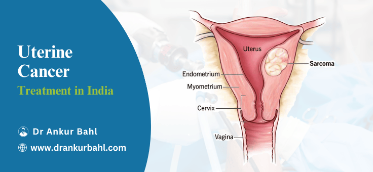 Uterine Cancer Treatment in India