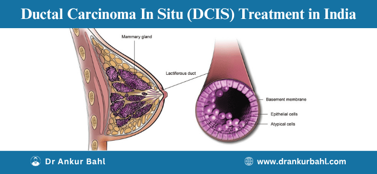 Ductal Carcinoma In Situ (DCIS) Treatment in India