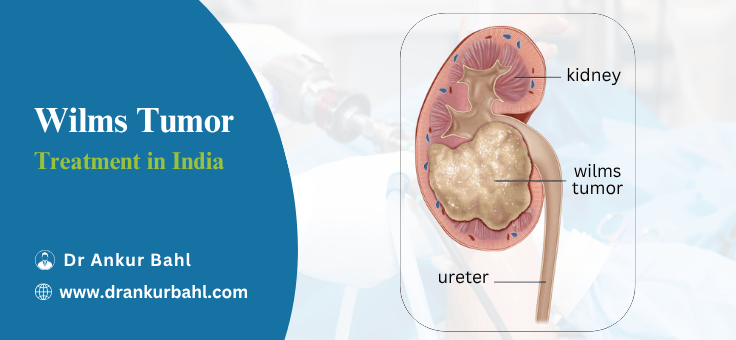 Wilms Tumor & Childhood Kidney Cancer Treatment in India