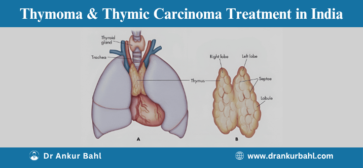 Thymoma & Thymic Carcinoma Treatment in India