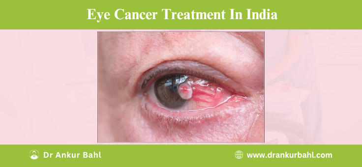 Eye Cancer Treatment in India