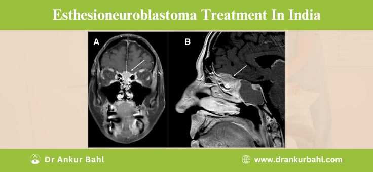 Esthesioneuroblastoma Treatment in India